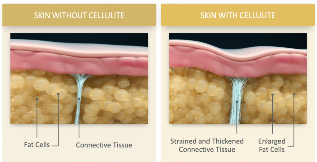 Cellulite with QWO | Ritual in Washington, DC