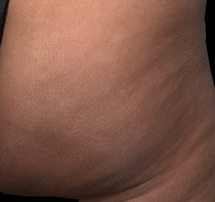 Cellulite with QWO | Ritual in Washington, DC
