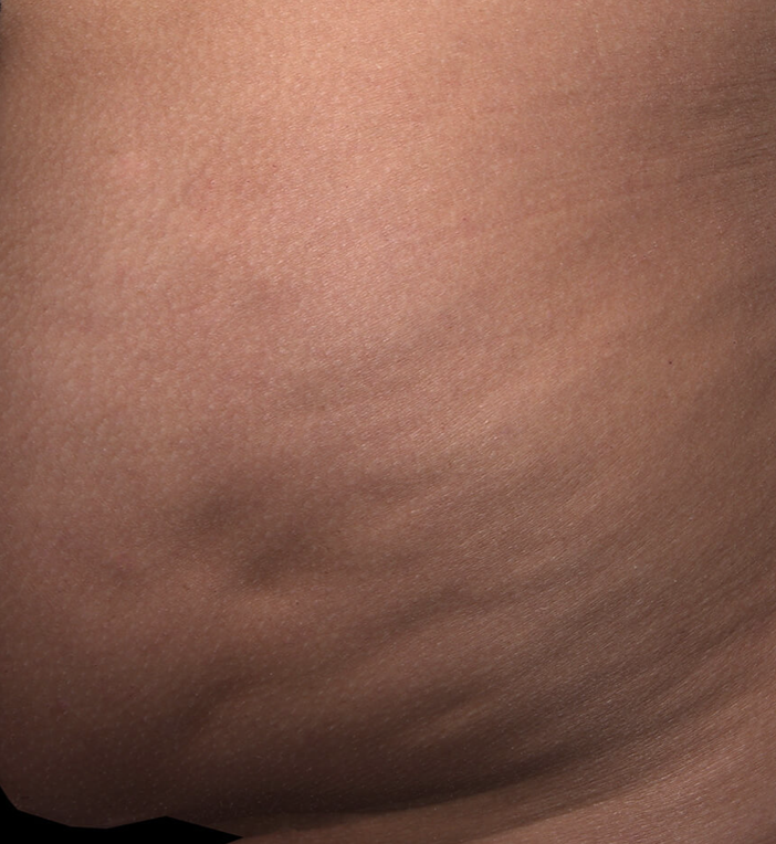 Cellulite with QWO | Ritual in Washington, DC