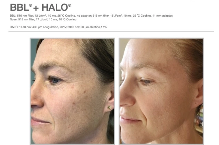 Moxi Before and After Result at Ritual by Tracy Holzman NP-C med spa in Washington DC