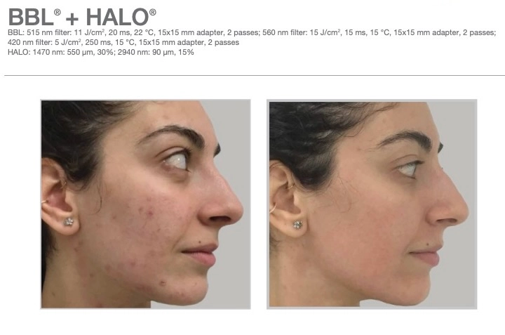 BBL Hero Before and After Results at Ritual by Tracy Holzman NP-C in Washington DC