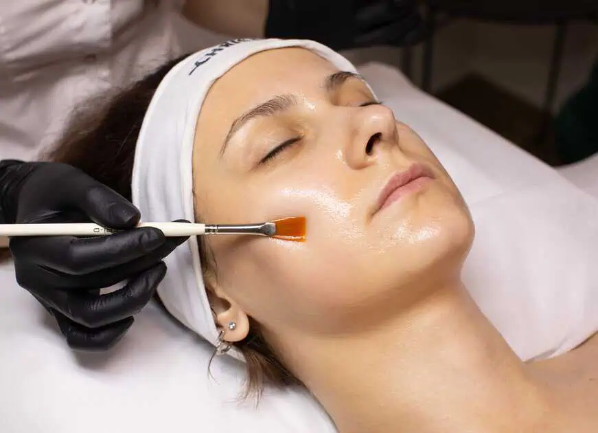 Perfect Derma Chemical Peels treatment in Washington, DC by Ritual By tracy Holzman