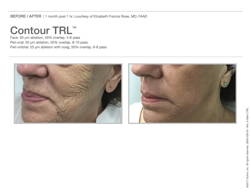 Sciton Contour TRL Resurfacing Treatment before and after result in Washington DC at Ritual by Tracy Holzman NP C