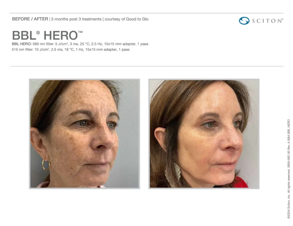BBL Hero Treatment before and after result in Washington DC at Ritual by Tracy Holzman NP C