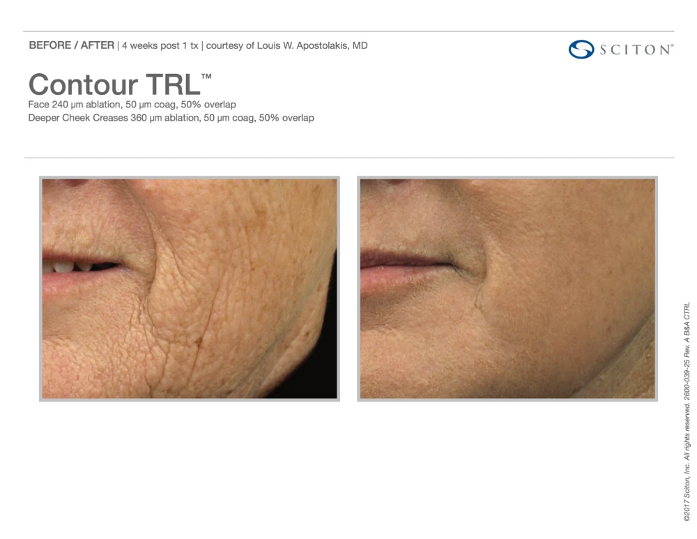 Sciton Contour TRL Resurfacing Treatment before and after result in Washington DC at Ritual by Tracy Holzman NP C