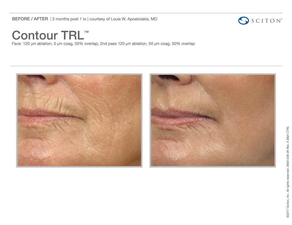 Sciton Contour TRL Resurfacing Treatment before and after result in Washington DC at Ritual by Tracy Holzman NP C
