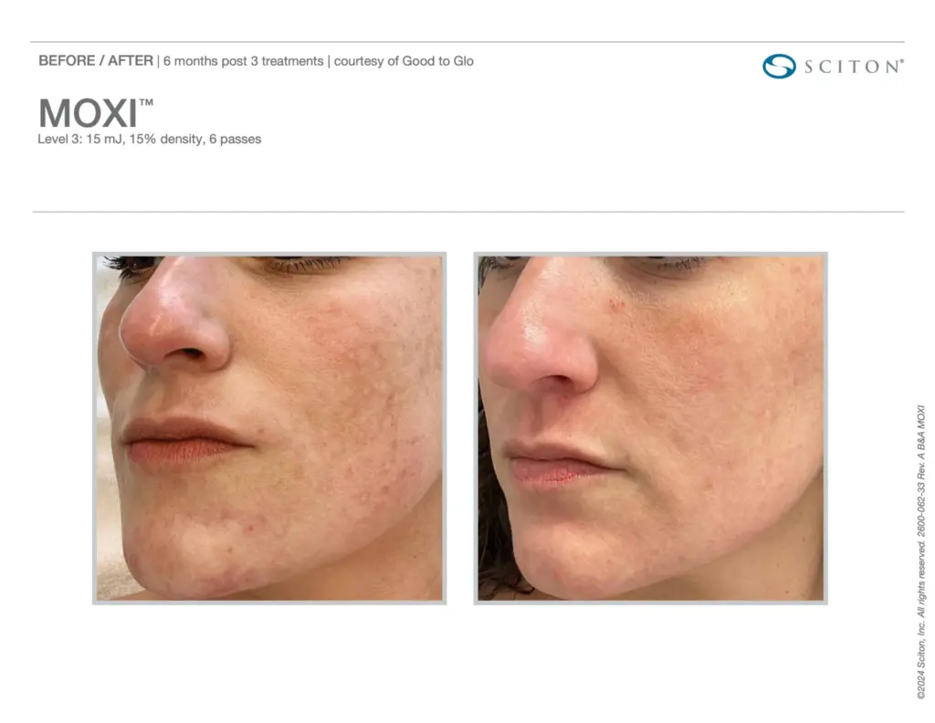 Moxi Treatment before and after result in Washington DC at Ritual by Tracy Holzman NP C