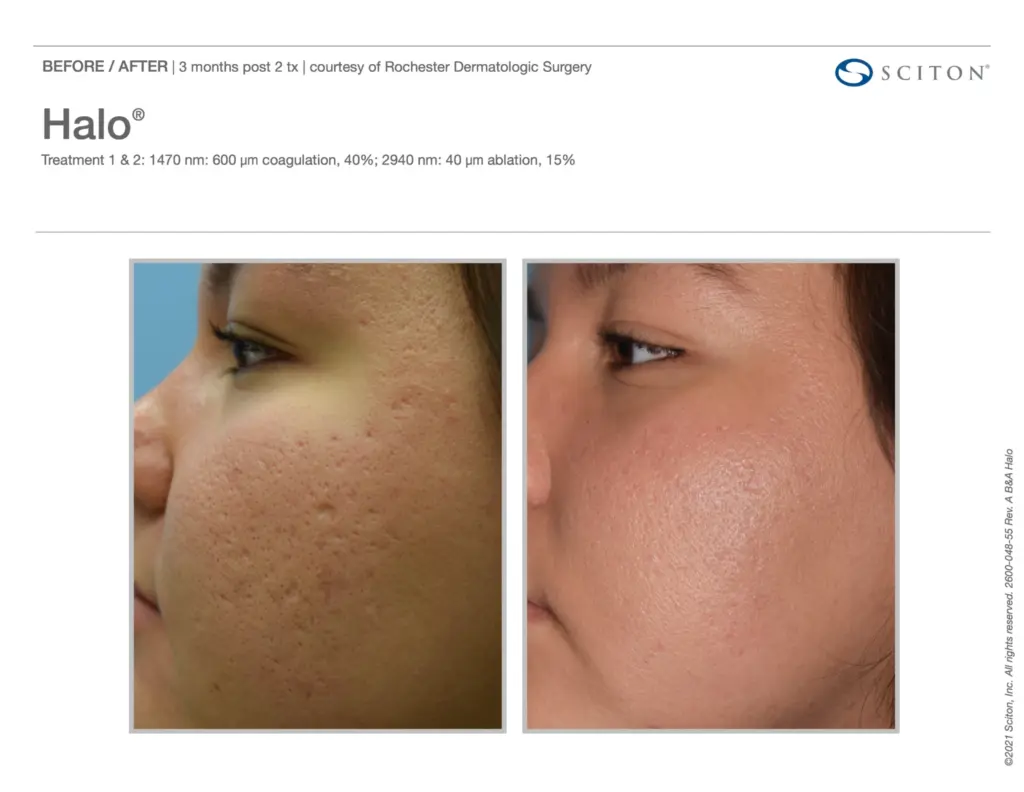 Halo Treatment before and after result in Washington DC at Ritual by Tracy Holzman NP C